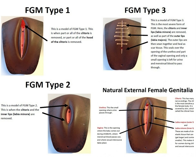 Tipos de Mutilación Genital Femenina